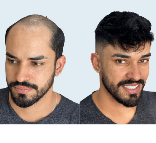Best Hair Bonding Center in Koramanagala