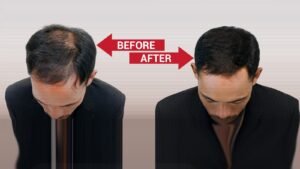 Best non Surgical Hair Replacement in Koramangala
