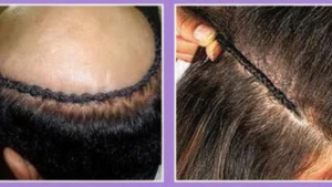 Hair Weaving in Bangalore