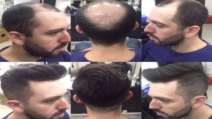hair replacement in koramangala