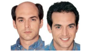 Best Hair Bonding Center in Koramanagala